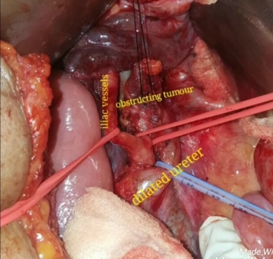 Resection of recurrence 